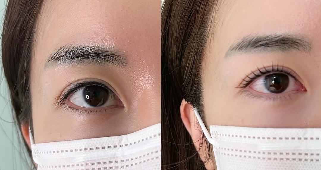 시술 전후 비교